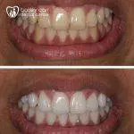 Teeth whitening