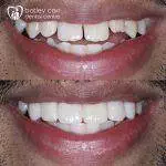 Composite veneers to improve the shapes and symmetry of teeth.