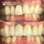 Fractured bridge under Ur1 root. New 4 unit-bridge constructed and a no prep veneer.