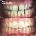 Invisalign and edge bonding