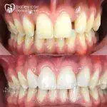 Composite edge bonding