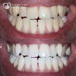 Teeth whitening