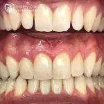 Composite edge bonding to improve shapes of teeth and aesthetics.
