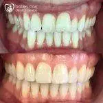 Invisalign and teeth whitening.