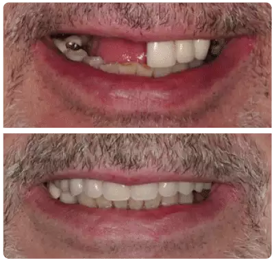 some of the cheapest dental implants near me at Batley Carr