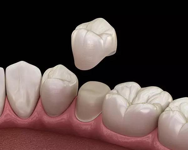 dental crowns batley carr